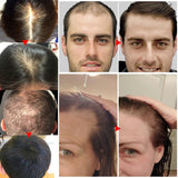 Fast Growing Hair, Essential Oils, Prevent Hair Loss Oil Scalp Treatment For Men Women