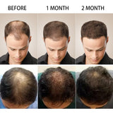 Fast Growing Hair, Essential Oils, Prevent Hair Loss Oil Scalp Treatment For Men Women